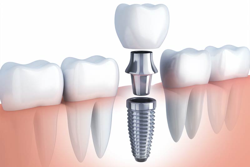 Implants Dentist in Waynesville