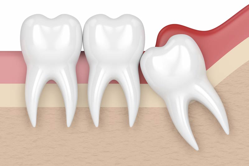 Wisdom Tooth Removal in Waynesville